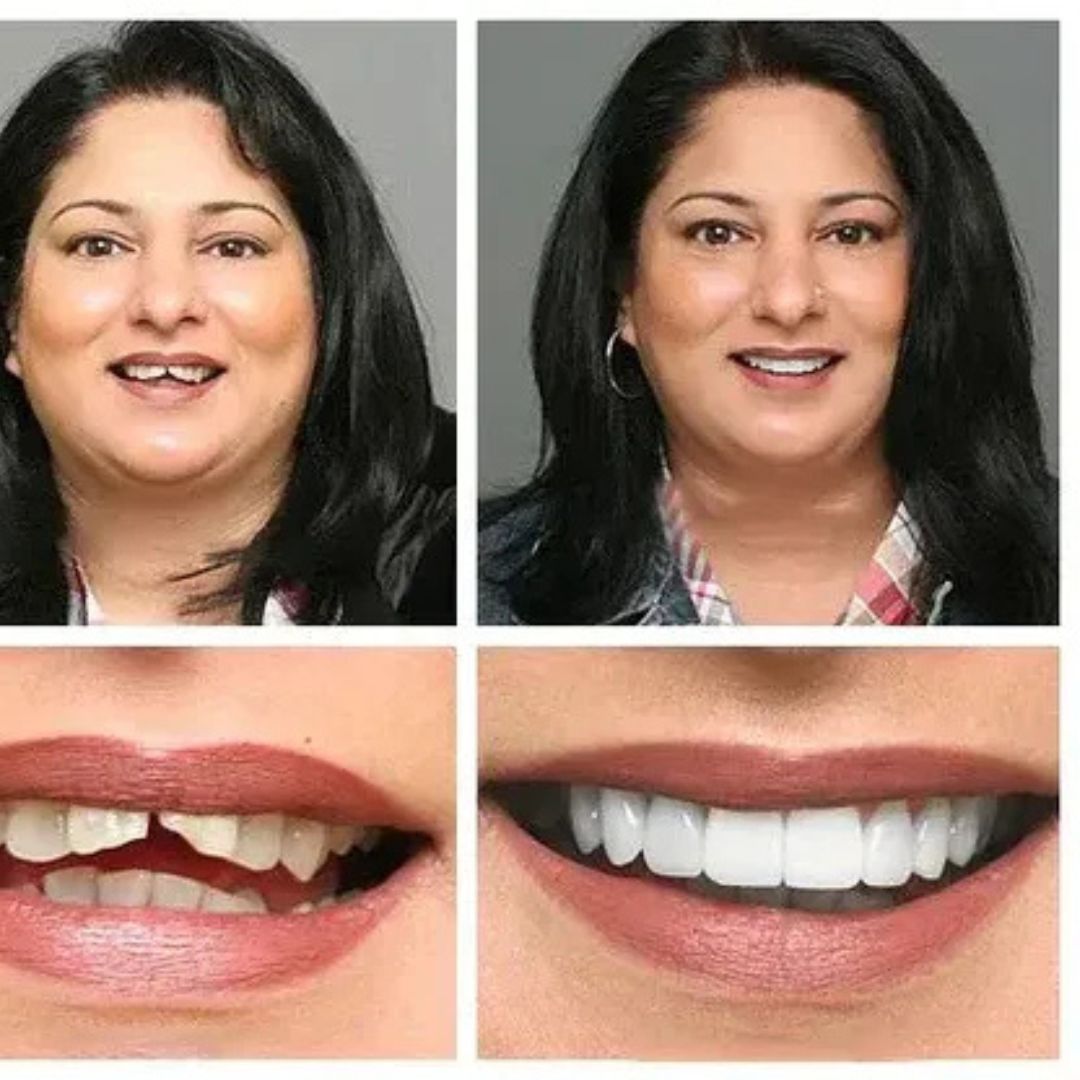 Magic Smile Teeth Braces (😍Buy 1 Get 2 FREE Today Only)