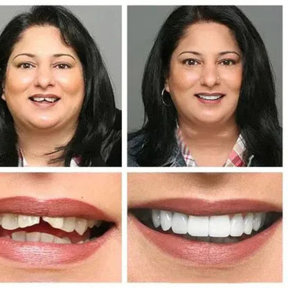 Magic Smile Teeth Braces (😍Buy 1 Get 2 FREE Today Only)