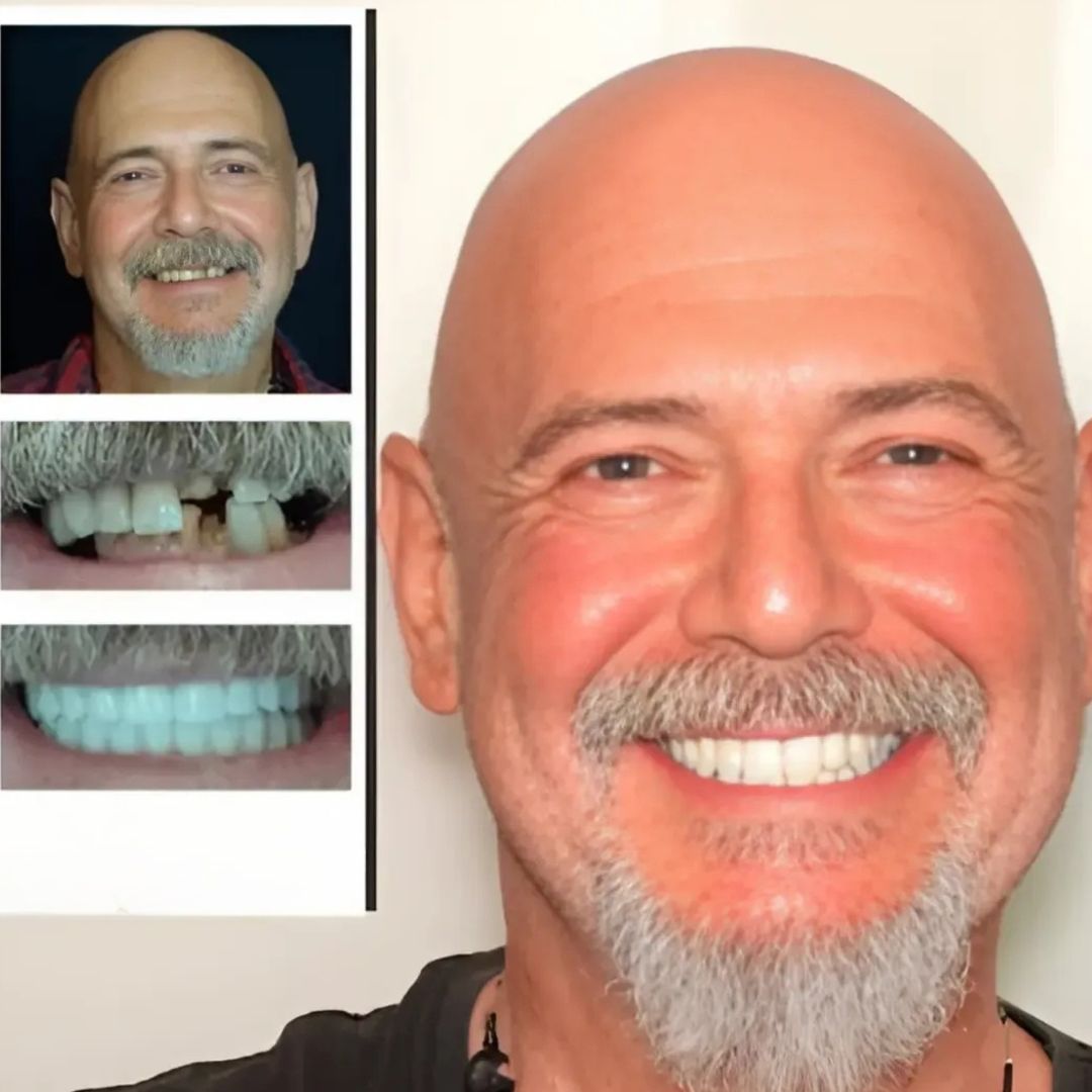Magic Smile Teeth Braces (😍Buy 1 Get 2 FREE Today Only)