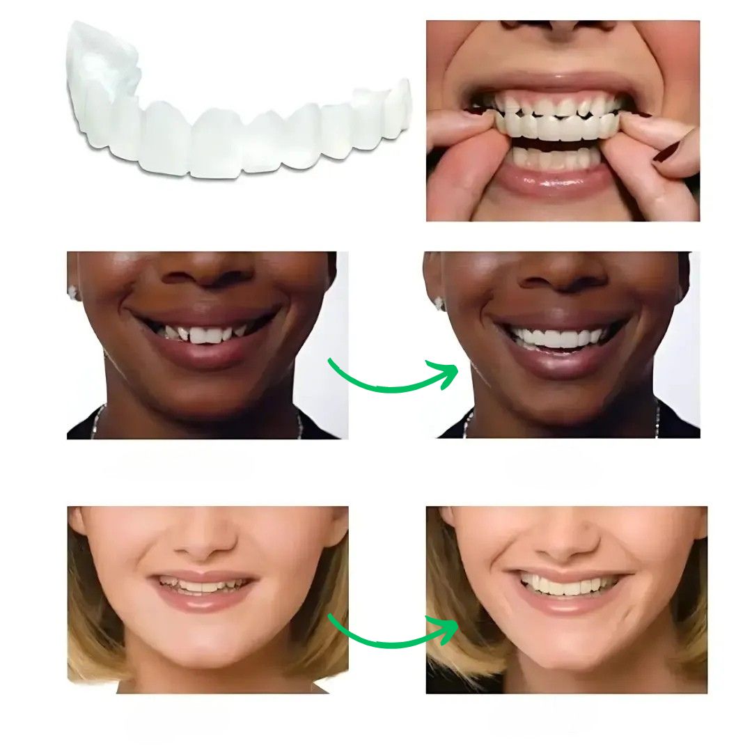 Magic Smile Teeth Braces (😍Buy 1 Get 2 FREE Today Only)
