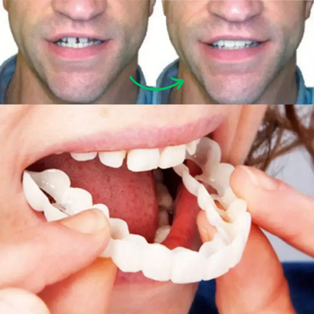 Magic Smile Teeth Braces (😍Buy 1 Get 2 FREE Today Only)