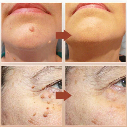 Tags & Moles Remover Cream (😍Buy 1 Get 1 FREE Today Only Offer)